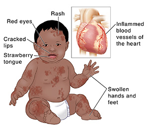 Front view of baby with skin rash, red eyes, cracked lips, strawberry tongue, and swollen hands and feet. An inset image shows heart with inflammed blood vessels.