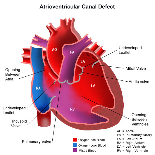 Anatomy of a heart with an atrioventricular canal defect