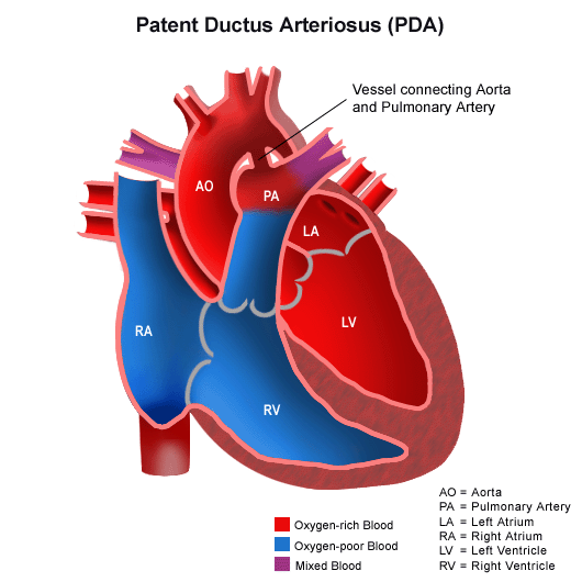 Anatomy of a heart with a patent ductus arteriosus