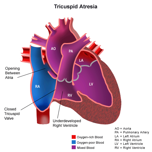 Anatomy of a heart with tricuspid atresia