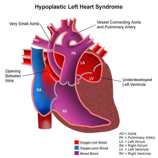 Anatomy of a heart with hypoplastic left heart syndrome