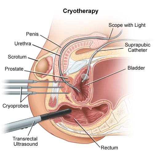 Illustration of cryotherapy procedure